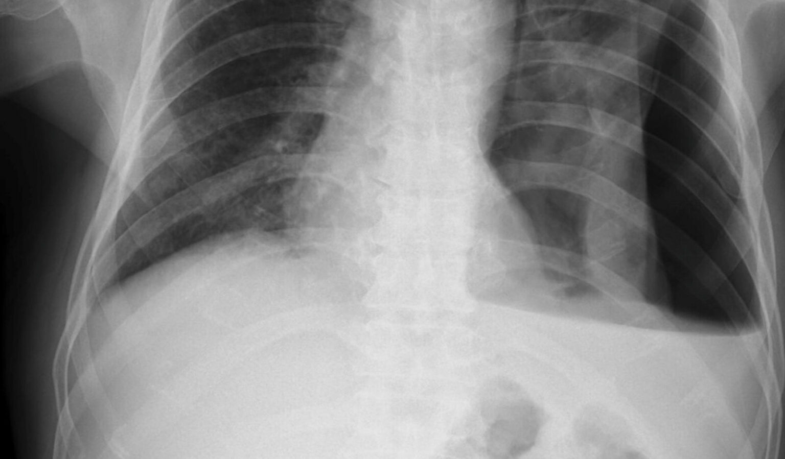 Hydro-point – The Forgotten and Unspoken Entity in Hydropneumothorax